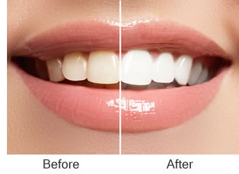 Teeth Whitening and Bleaching - Drs. Blincoe & Shutt Family Aesthetic Dentistry